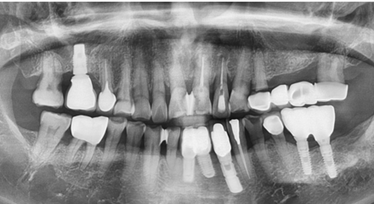 사례 01 파노라마 X-ray — After