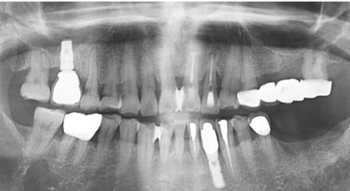 사례 01 파노라마 X-ray — Before