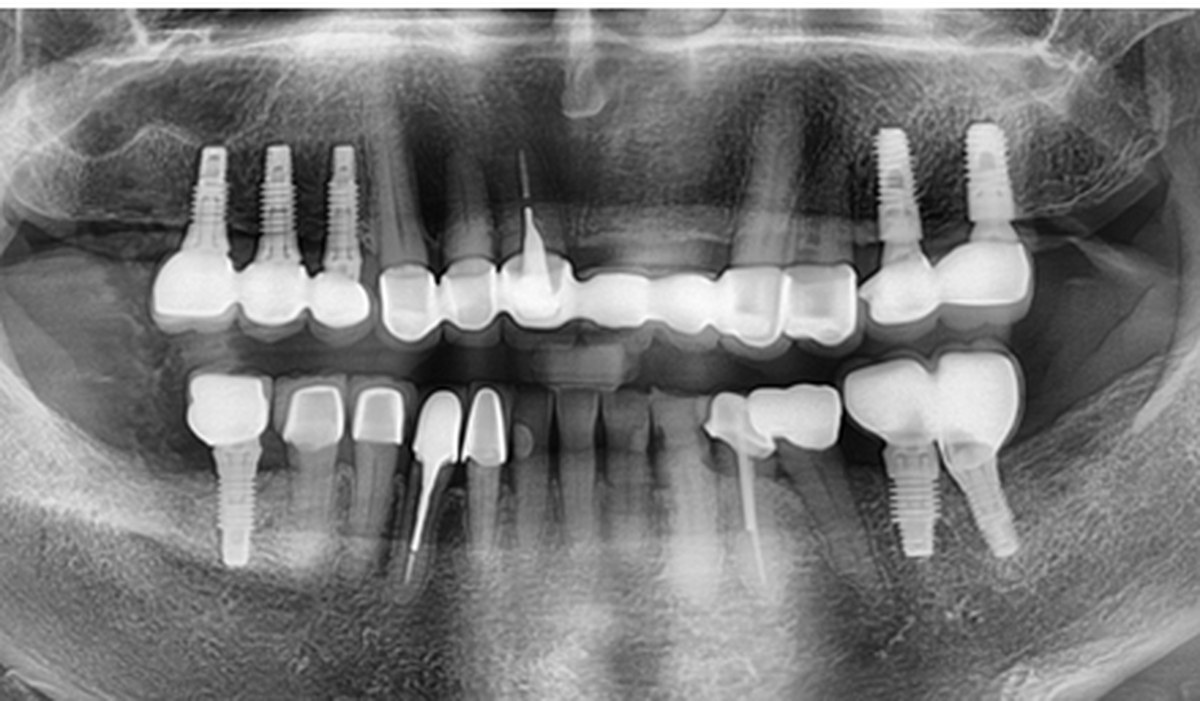 사례 02 파노라마 X-ray — After