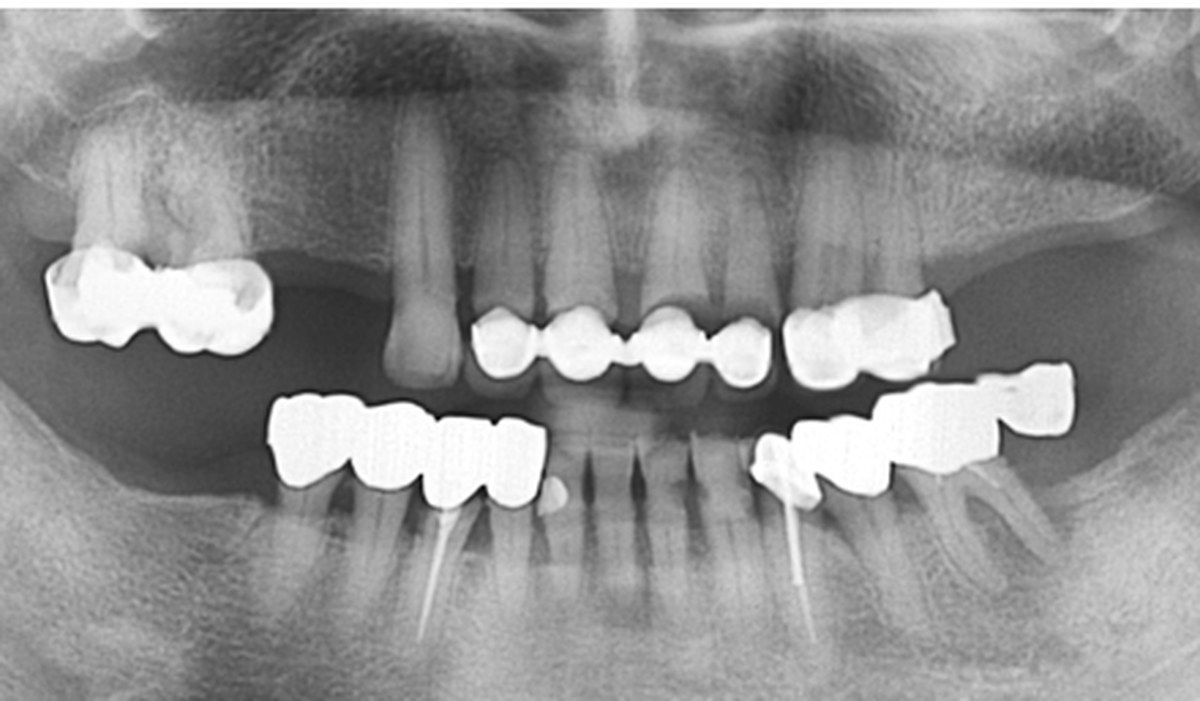 사례 02 파노라마 X-ray — Before