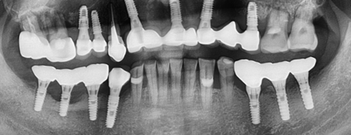 사례 03 파노라마 X-ray — After