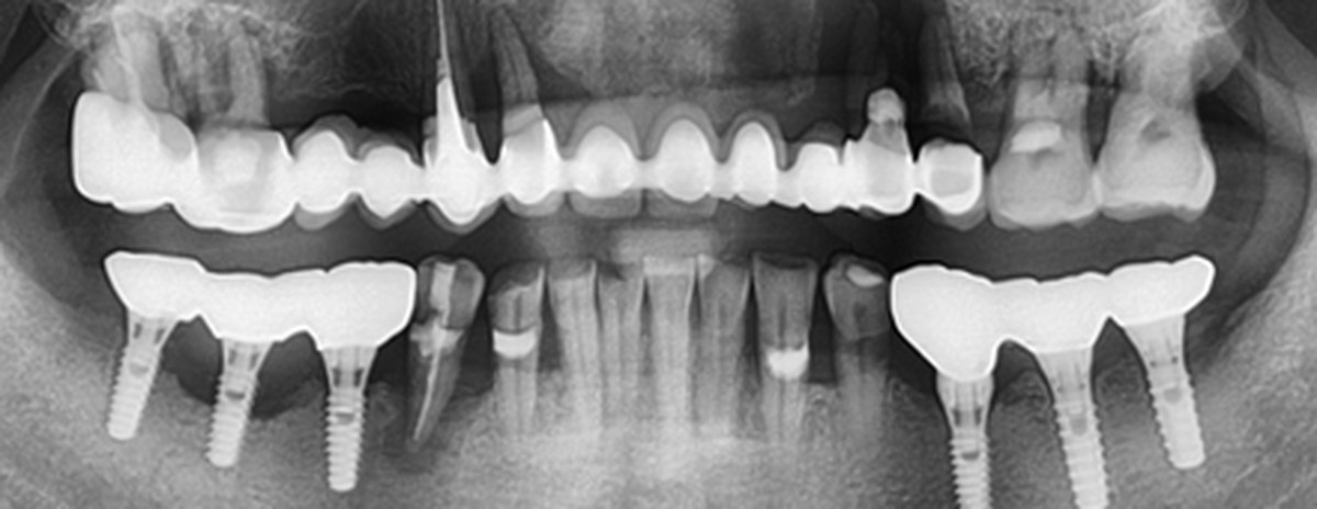 사례 03 파노라마 X-ray — Before