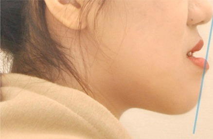 교정 전 · 측면 윤곽