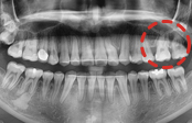 치료 후 — 파노라마 X-ray