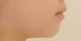 치료 후 — 측면