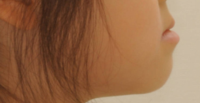 치료 전 — 측면