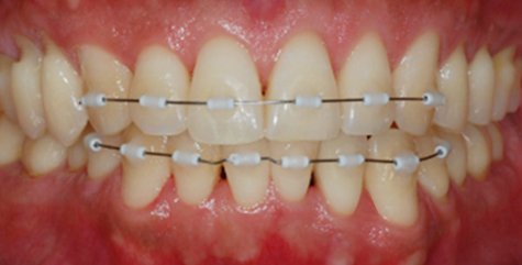 부분교정 — 정면 구강 (앞니 부분 brackets)