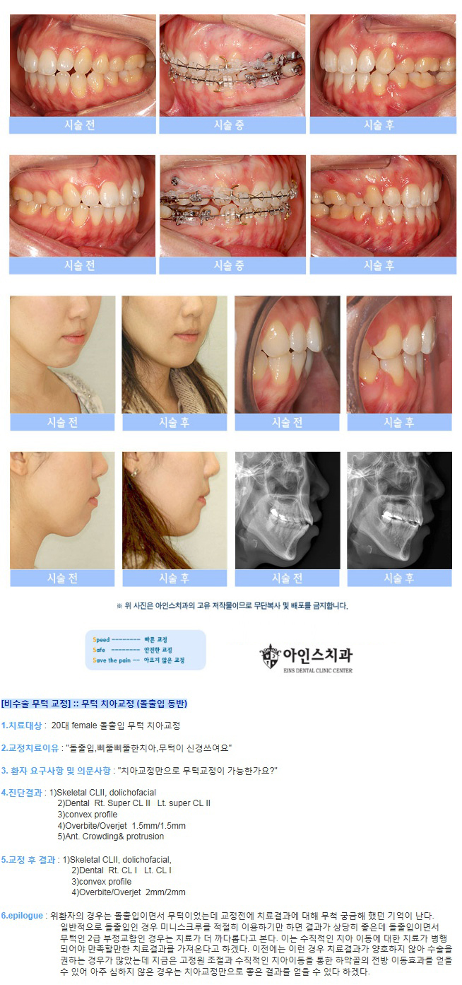 [비수술 무턱 교정] 돌출입을 동반한 무턱 치아교정
